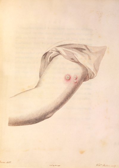 Brazo de William Pead usado para la vacuna contra la viruela, de 